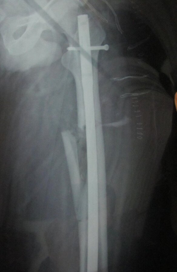 2-ameliyattan sonra.JPG